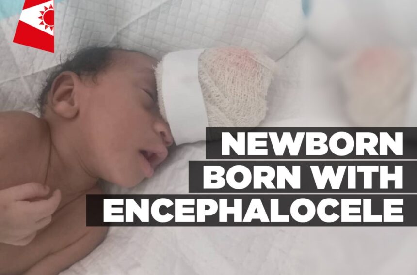 Newborn born with encephalocele – Informanté